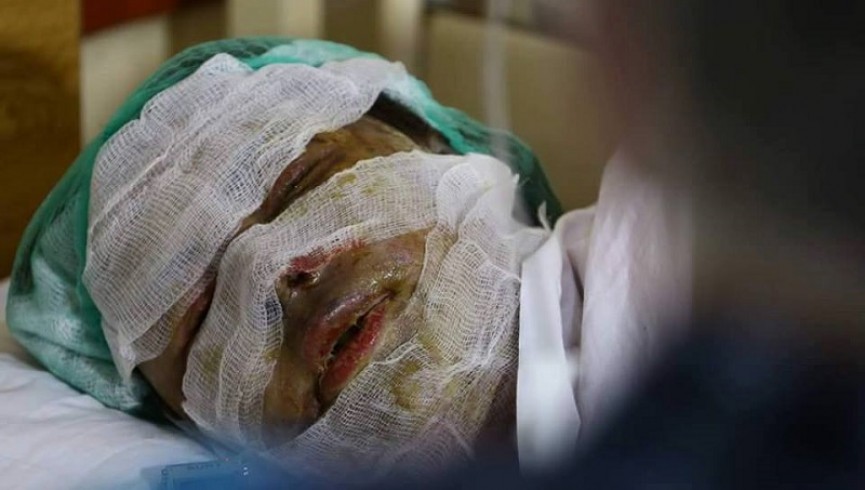 اسیدپاشی بر صورت یک سرمعلم زن در هرات