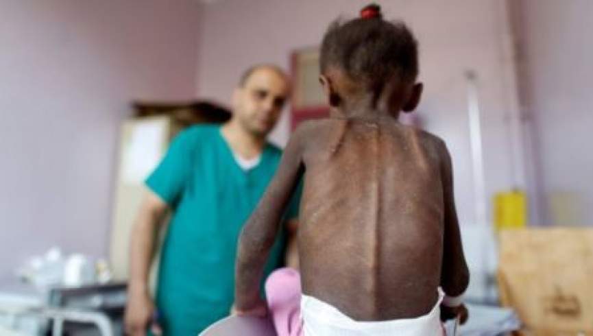 سناتور امریکایی: 85 هزار کودک یمنی زیر 5 سال از سوءتغذیه جان داده‌اند