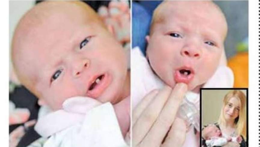 تولد طفلی با یک دندان