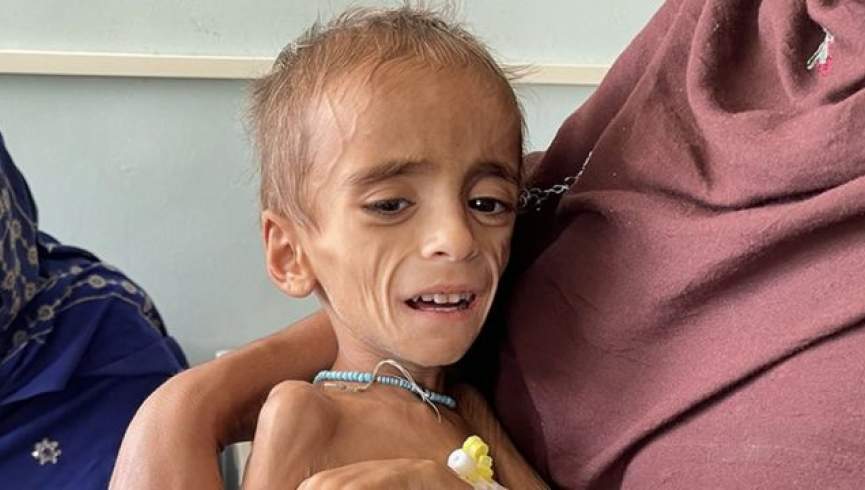افغانستان کې په خوار ځواکۍ د اخته ماشومانو شمېر مخ پر زیاتېدو دی