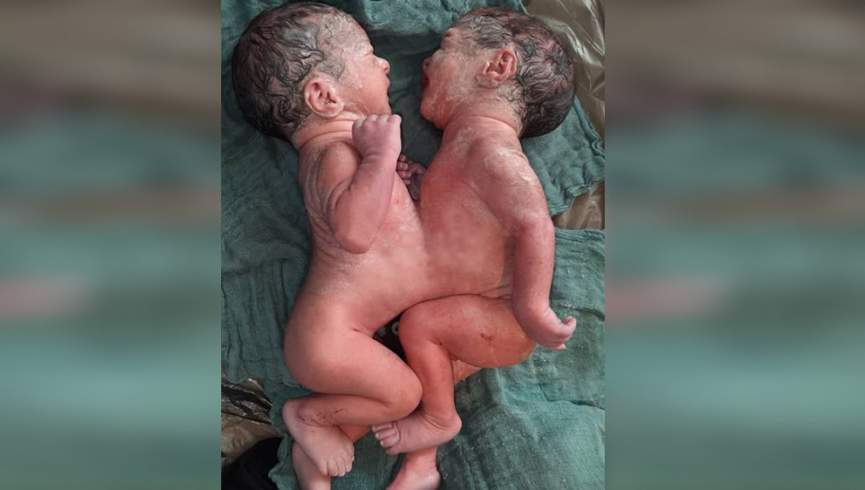 دو نوزاد به هم چسبیده در میدان‌ وردک متولد شدند
