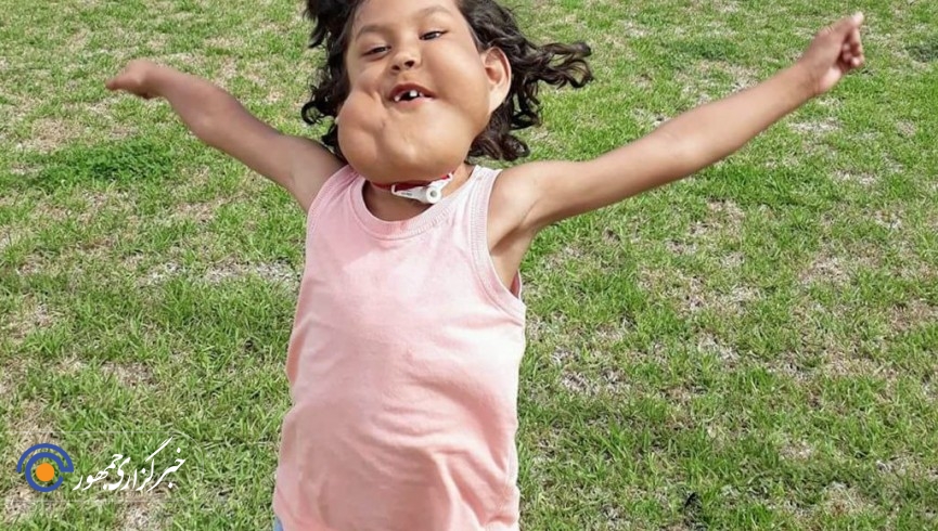 بیماری عجیب در صورت پسر ۴ ساله مکزیکی  